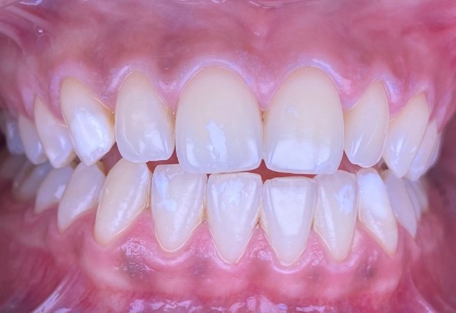 Evde diş beyazlatma işlemi hakkında en çok merak edilen şeyler