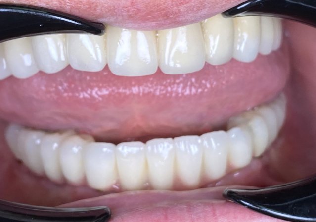 Güvenli ve estetik bir gülümseme için all on six implant tedavisi